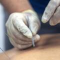 Acupuntura na urologia: a ciência e o bem-estar masculino