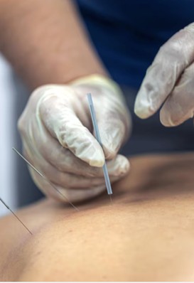 Homem realiza sessão de acupuntura. A acupuntura na urologia deixou de ser um tema marginal há tempos.