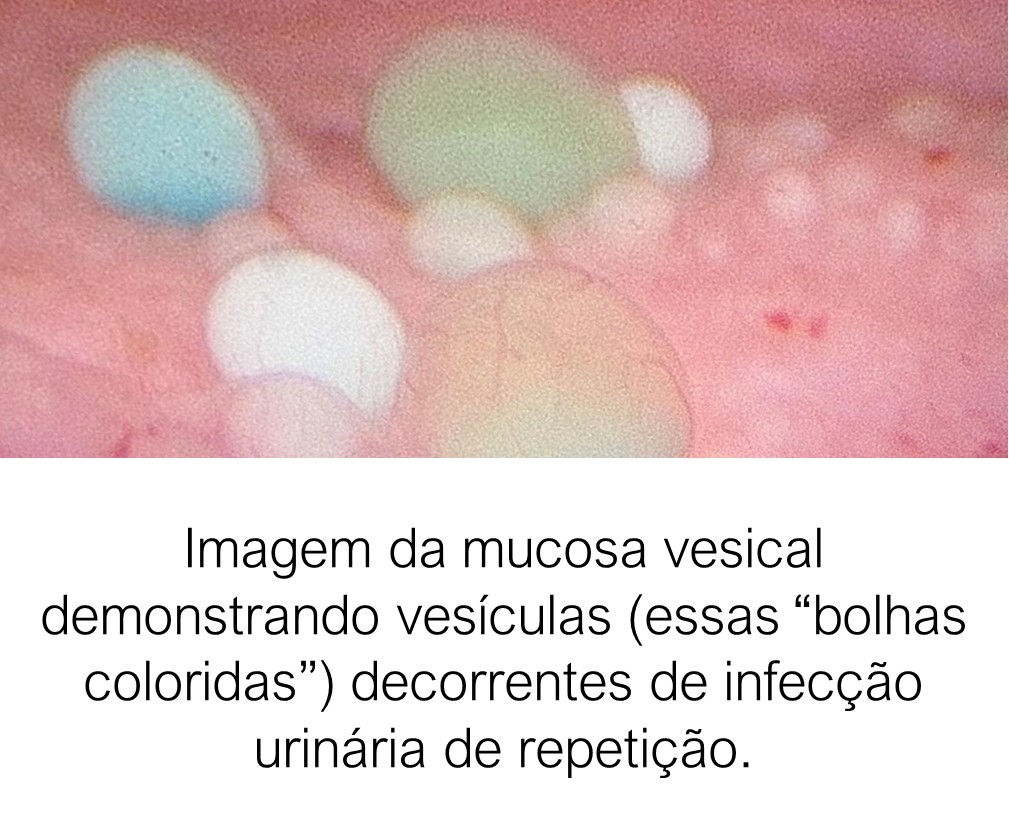 Imagem da mucosa vesical demonstrando vesículas (essas “bolhas coloridas”) decorrentes de infecção urinária de repetição.
