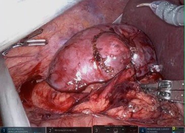 Foto de uma nefrectomia parcial robótica: note as pinças do robô, e o rim ao centro com o tumor demarcado 