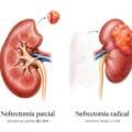 Nefrectomia parcial ou radical: quando é possível preservar o rim?