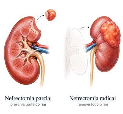 Imagem gráfica mostra dois rins: A nefrectomia parcial (e) remove o tumor preservando a parte saudável do rim, enquanto a nefrectomia radical (d) remove todo o rim. Para tumores renais localizados classificados como T1, as diretrizes atuais recomendam a nefrectomia parcial quando tecnicamente possível, porque ela oferece controle oncológico comparável em muitos casos e preserva melhor a função renal