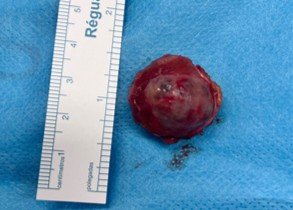 Tumor renal de 2,5cm retirado de um rim é visto ao lado de uma régua quantificando o seu tamanho.