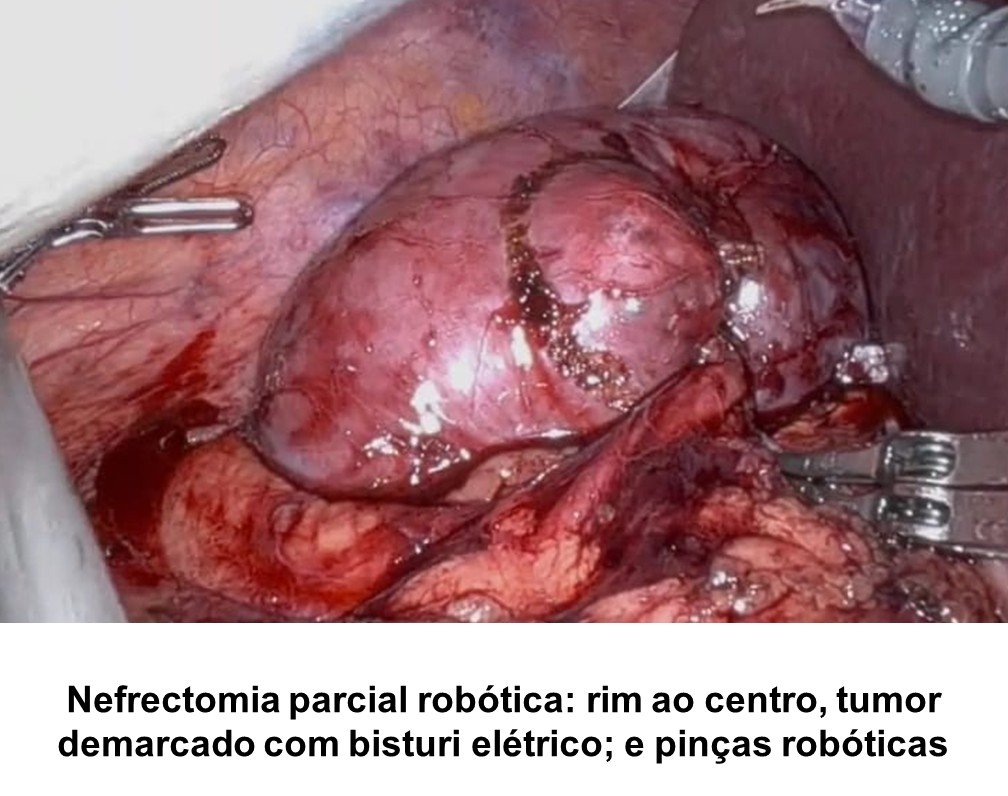 Nefrectomia parcial robótica: rim ao centro, tumor demarcado com bisturi elétrico; e pinças robóticas