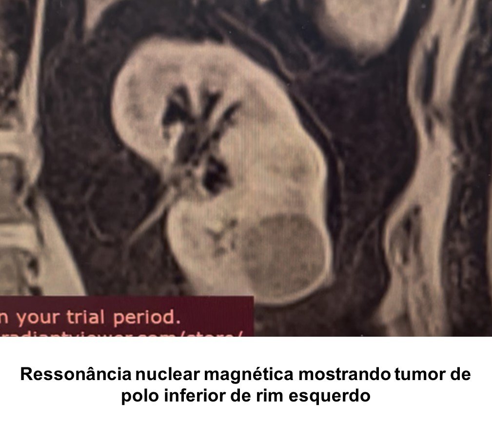 Ressonância magnética mostrando tumor de polo inferior de rim esquerdo