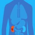Nódulo no rim: todo nódulo renal é câncer?