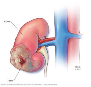 Imagem ilustrativa de um tumor em um rim: um cisto é uma estrutura que contém líquido, enquanto uma massa sólida pode representar um tumor.