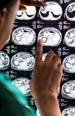 Profissional da saúde avalia exames de imagem: a massa renal
é um termo que geralmente descreve uma lesão que ocupa espaço no rim.
Não significa automaticamente que é câncer.