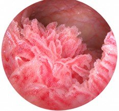 Tumor de bexiga visto na cistoscopia